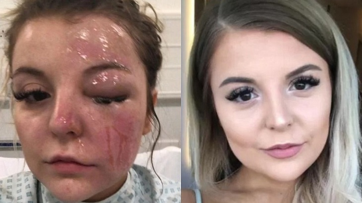 joven perdio la vista de un ojo por explosion de huevos en microondas