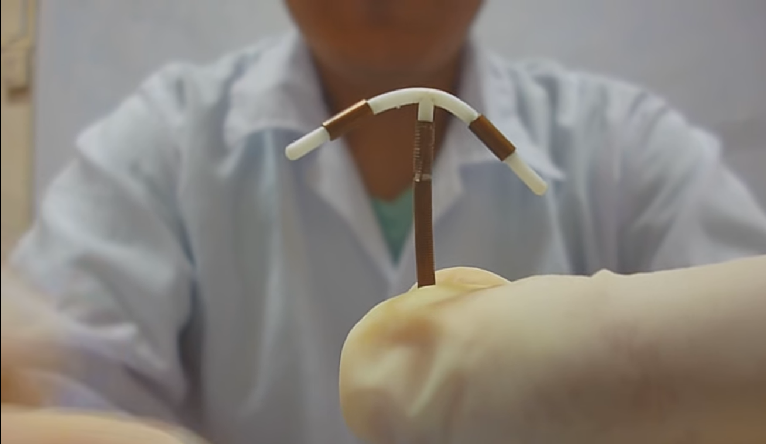 La 'T' de cobre: uno de los métodos anticonceptivos más efectivo y menos usado en Chile