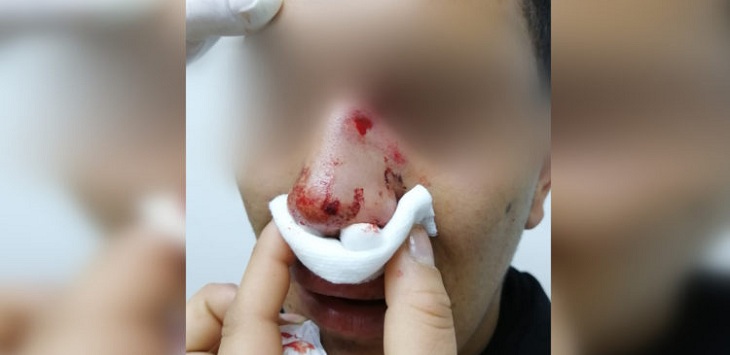 Acusan agresión homofóbica: golpean con puños y botellazos a joven de 20 años en Viña del Mar