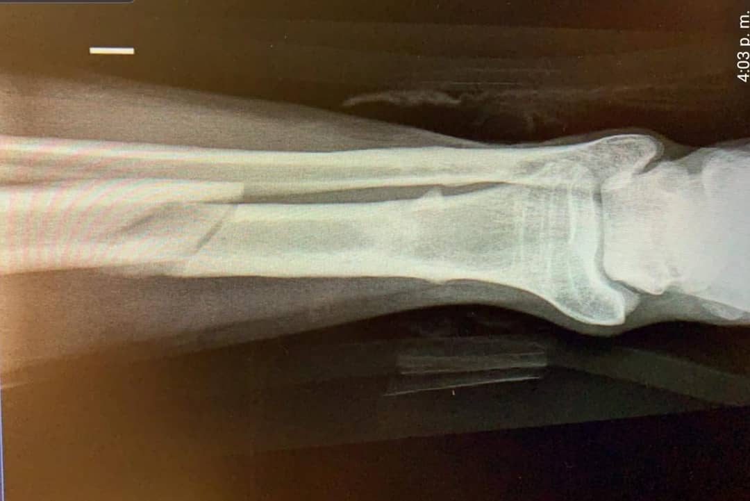 Matías Assler entregó detalles de su lesión y envió especial agradecimiento a Juanita Ringeling