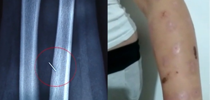 Madre de niña de 14 años denuncia que aguja de vacuna quedó en el brazo de su hija: 