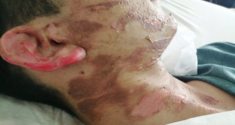 Feria de ciencias termina con 4 alumnos quemados: compañera habría lanzado alcohol a maqueta