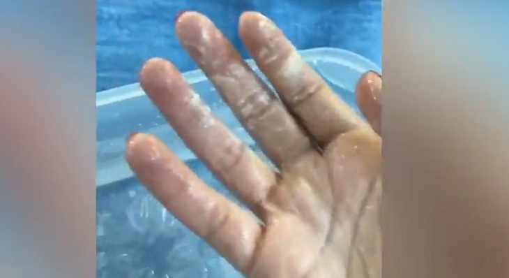 quemaduras mano cristina morales