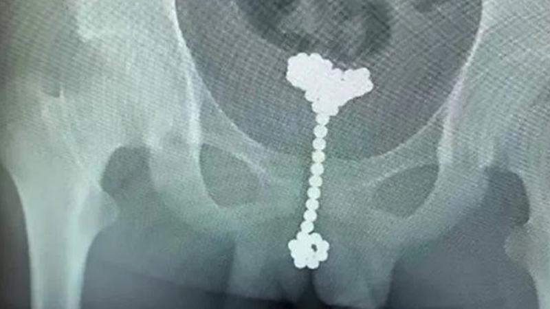 China: niño introdujo 31 bolas magnéticas de metal en su pene para 'explorar su cuerpo'