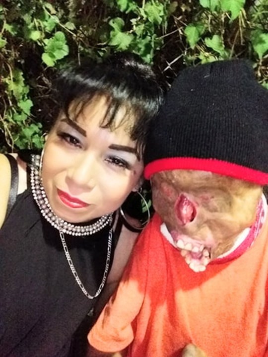 Impactante caso de joven que sufrió accidente por culpa de una vela