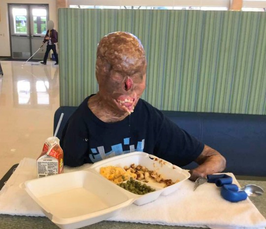 Impactante caso de joven que sufrió accidente por culpa de una vela