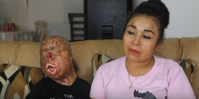 Crudo caso de joven que por culpa de una vela sufrió accidente: lo dejó con graves quemaduras