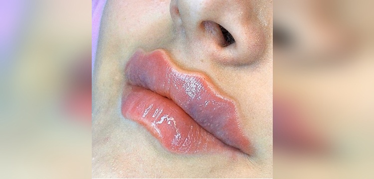 'Devil lips': la nueva intervención estética en labios que es tendencia y genera controversia