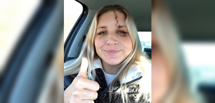 Arquera de Liverpool quedó con profunda cicatriz tras brutal patada: se comparó con Harry Potter