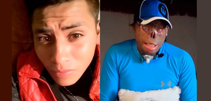 Dramático caso: joven quedó con el rostro desfigurado tras accidente y mujer lo abandonó con su hijo