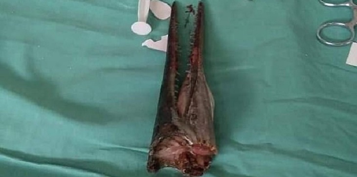 Adolescente pescaba en río de Indonesia y pez aguja saltó al bote: atravesó su cuello y cráneo