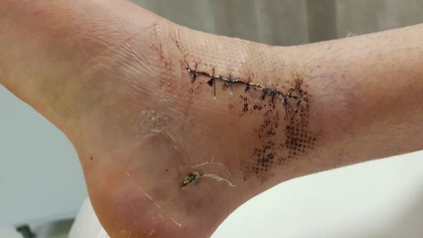 tobillo eden garrity accidente