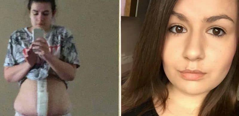 Mujer pensó que estaba embarazada y resultó tener un quiste canceroso de más de 6 kilos