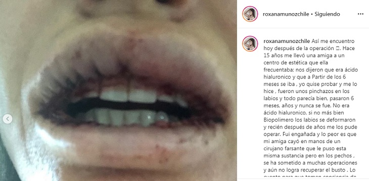 roxana muñoz cirugia