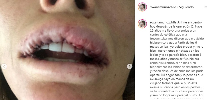 roxana muñoz cirugia