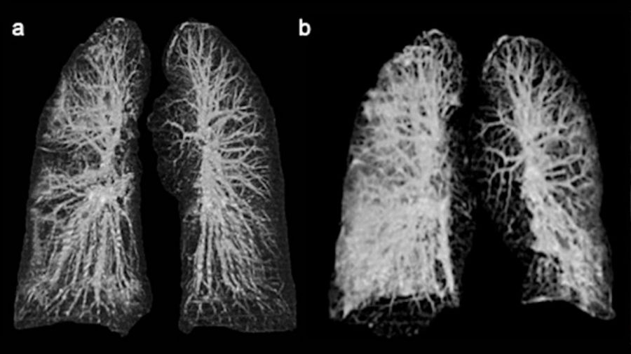 Pulmones de pacientes con coronavirus