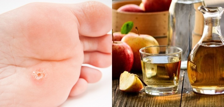 ¿No puedes sacar las verrugas de tu cuerpo? Estos remedios naturales te podrían ser de mucha ayuda