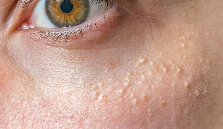 Quistes Milium | Estética Médica BLO