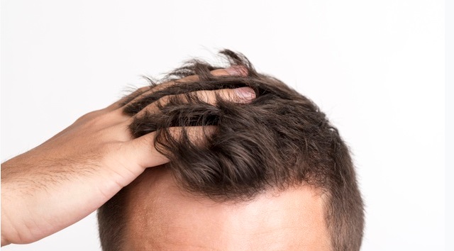 ¿Pierdes mucho cabello? Las señales que podrían ser preocupantes para tu cuero cabelludo