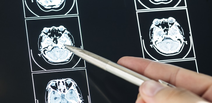 Neurólogo explicó posibles secuelas que se podrían generar a nivel cerebral tras superar COVID-19