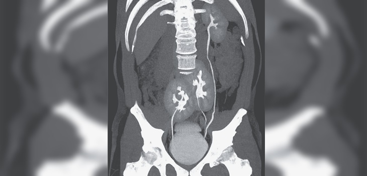 Hombre que fue al hospital por un fuerte dolor en la espalda se enteró que tenía tres riñones