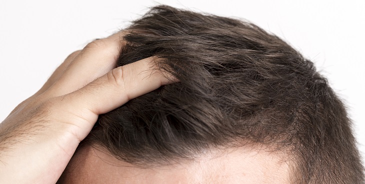 ¿Caspa, resequedad o dermatitis? Estas son las diferencias de estas afecciones del cuero cabelludo