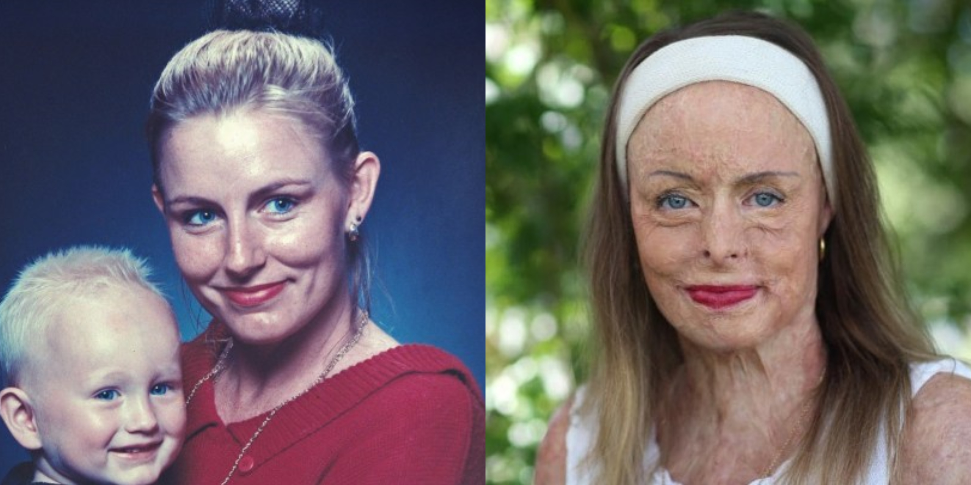 Mujer que sufrió quemaduras en el 85% de su cuerpo posó desnuda para enviar mensaje de superación