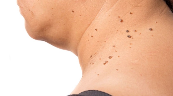 ¿Debes preocuparte? Las causas por las que aparecen los lunares de carne o acrocordones