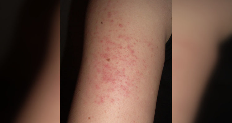 Queratosis pilaris: la afección cutánea que forma 'bultitos' ásperos en la piel y que no tiene cura