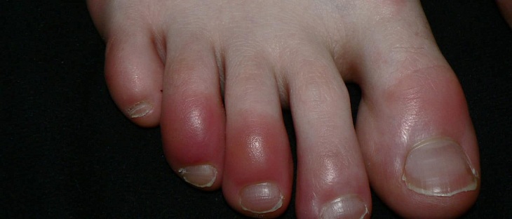 Estudio inglés asegura que pacientes jóvenes de COVID-19 podrían presentar sabañones