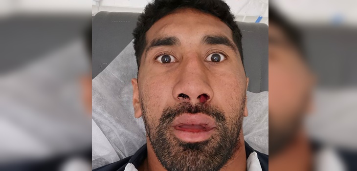 Rugbista de Australia sufrió escalofriante fractura facial: por suerte se salvaron sus dientes