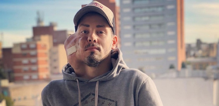 La inspiradora historia de joven argentino que lucha hace años con agresivo cáncer de cara