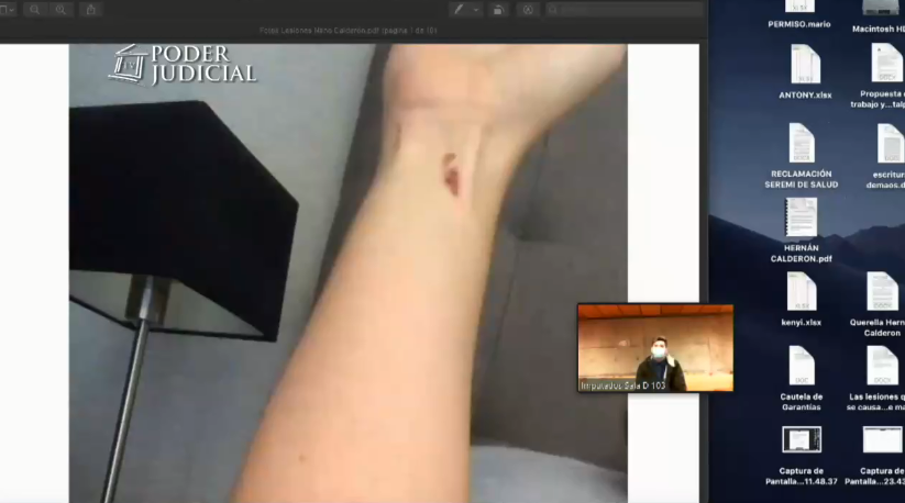 Fotos de heridas de Nano Calderón 