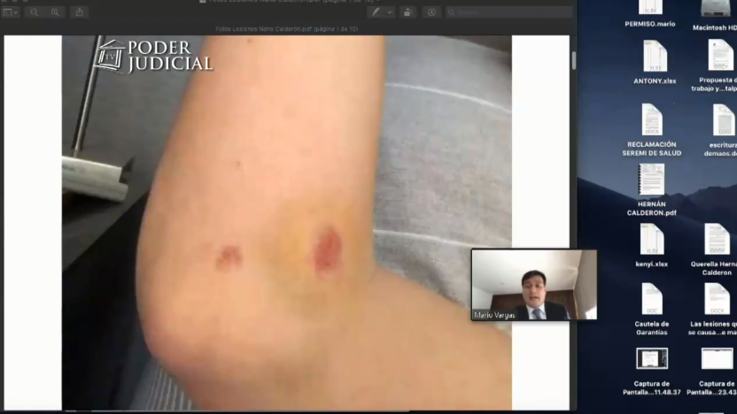 Fotos de heridas de Nano Calderón 