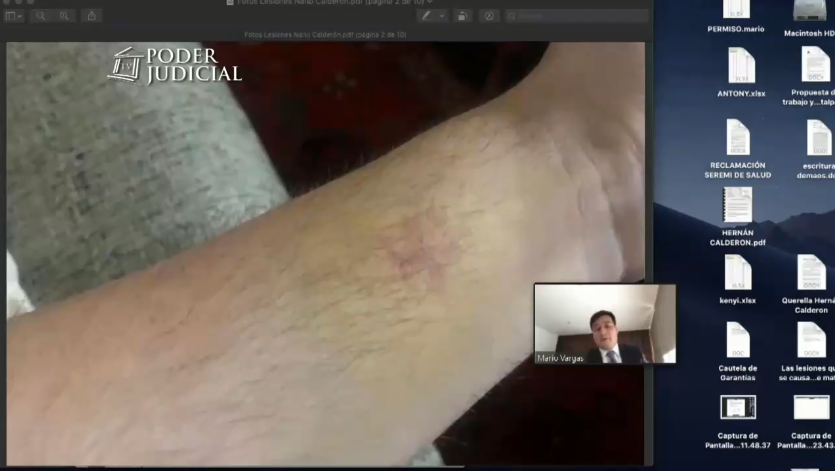 Fotos de heridas de Nano Calderón 