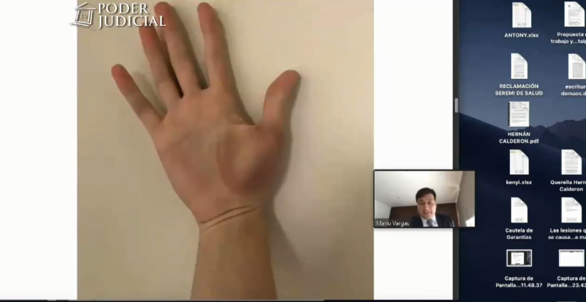 Fotos de heridas de Nano Calderón 