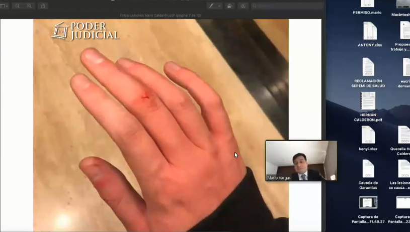 Fotos de heridas de Nano Calderón 