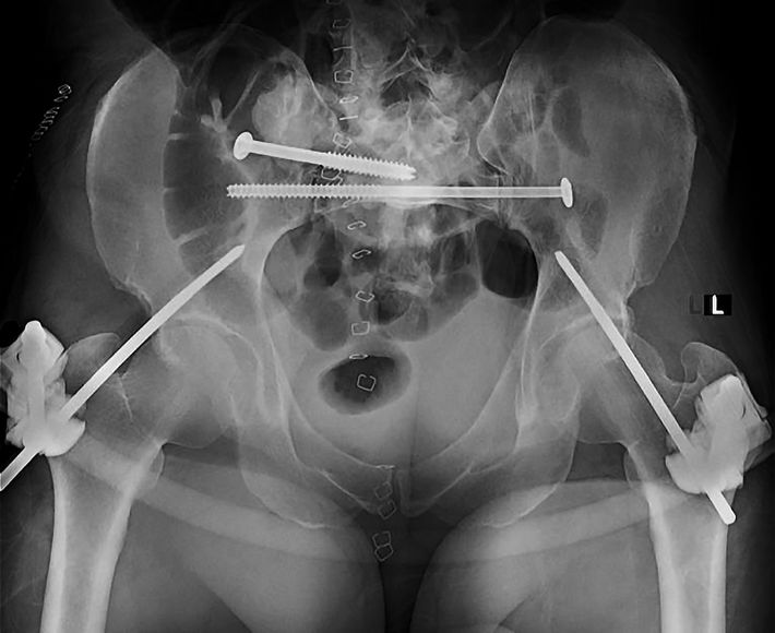 El caso de hombre que quedó con el cuerpo destrozado y que se recuperó gracias a la realidad virtual