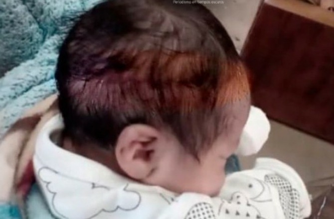 Denuncian negligencia en México tras cesárea: