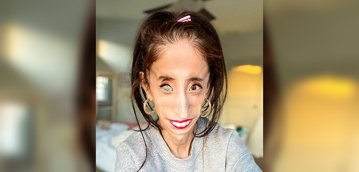 Joven con rara enfermedad pidió a padres que no utilicen su rostro para cruel broma viral