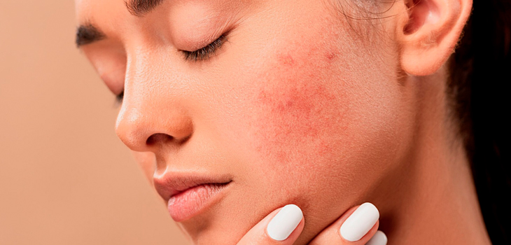 Acné por uso de la mascarilla: expertos explican qué es el 'maskné' y cómo tratarlo
