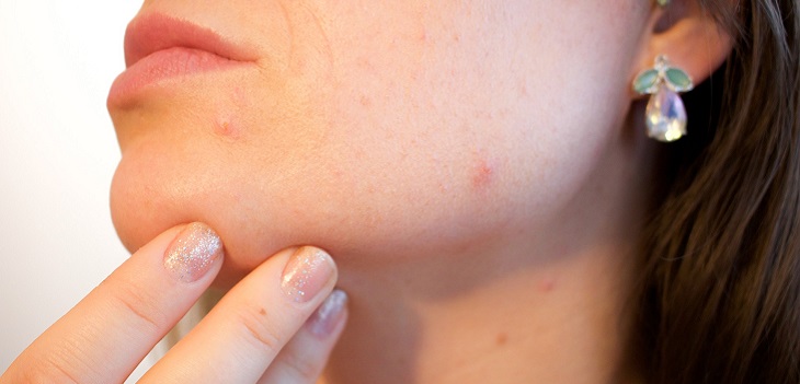 Espinillas, granos, puntos negros