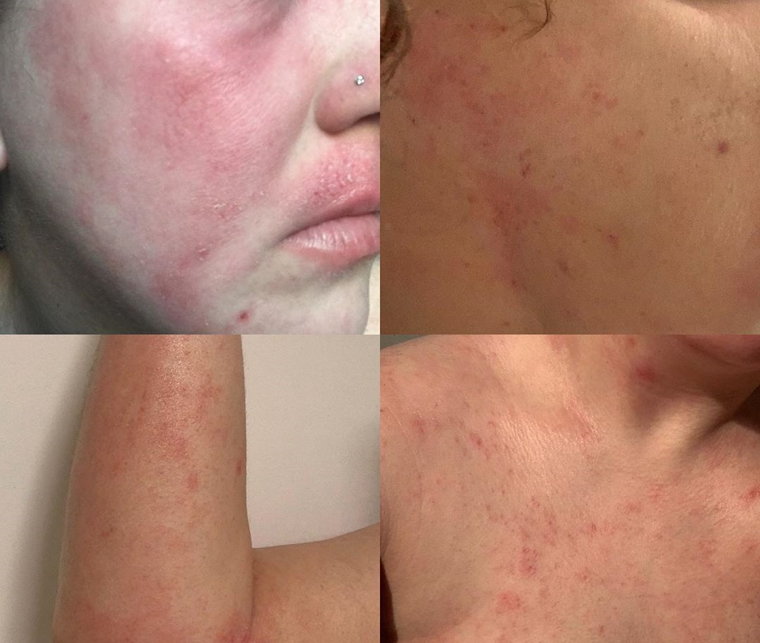 Elle Fanning mostró los efectos del eccema en su rostro: ¿de qué trata esta afección?