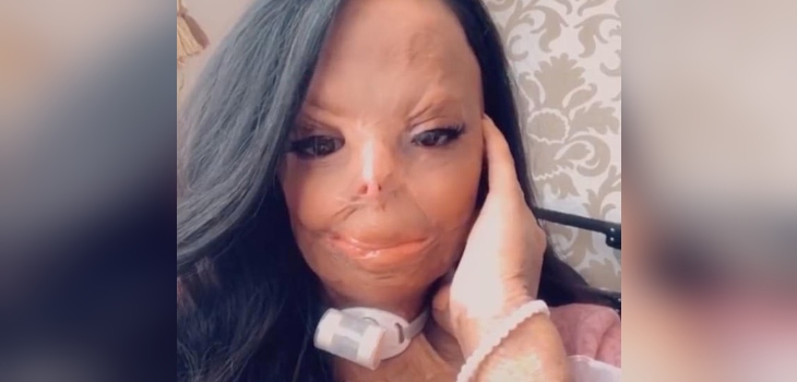 La sincera reflexión de joven que sufrió graves quemaduras en su cuerpo: 