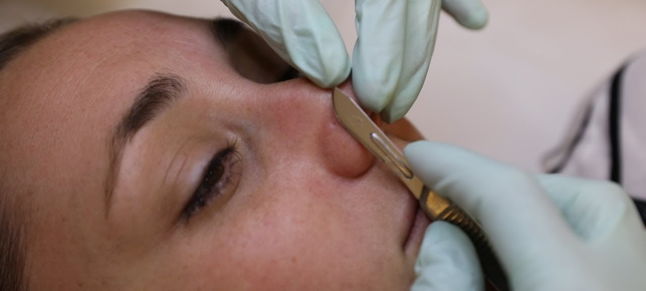 Dermaplaning: los beneficios y todo lo que tienes que saber del tratamiento 