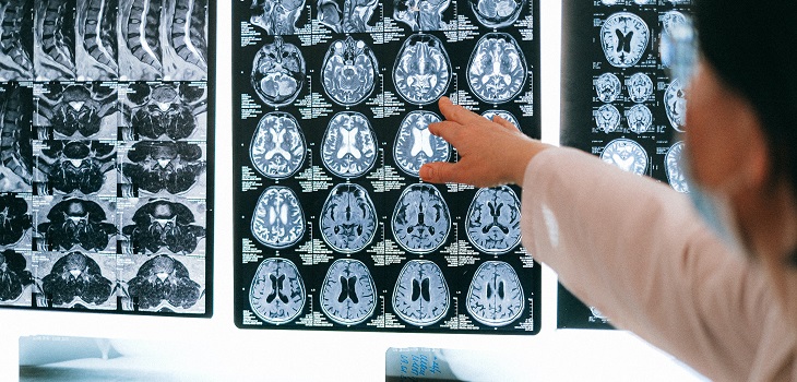 Estudio inglés afirma que COVID-19 envejece el cerebro 10 años y reduce el CI en 8,5 puntos