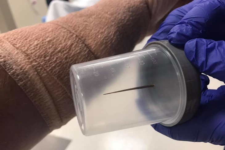 Hombre vivió cuatro años con espina alojada en su brazo: pensaba que era un tendón roto