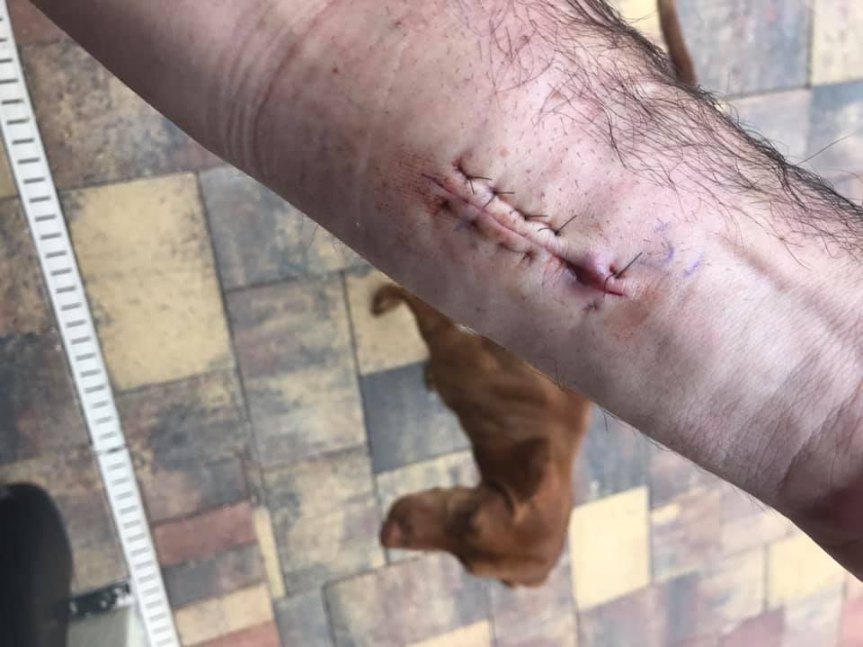 Hombre vivió cuatro años con espina alojada en su brazo: pensaba que era un tendón roto