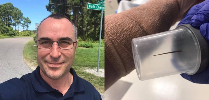 Hombre vivió 4 años con una gran espina alojada en su brazo: pensaba que se le había roto un tendón