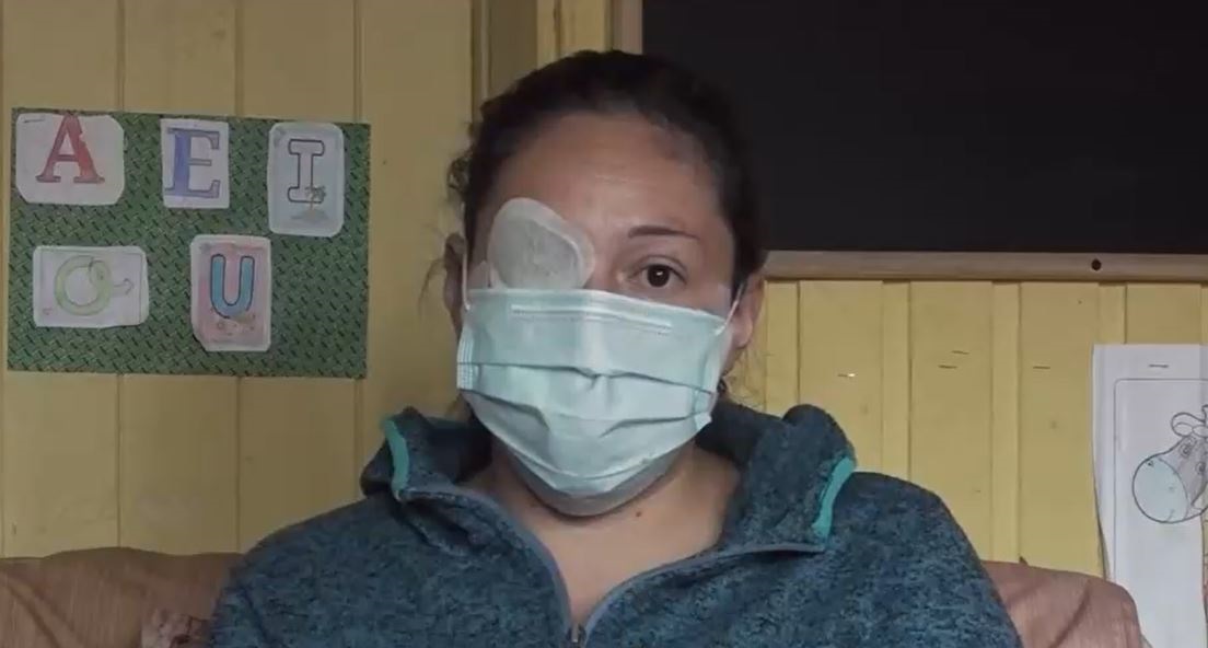 El relato de mujer que fue atacada con ácido en Fresia: expareja quedó en prisión preventiva